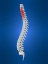 Slipped disc Royalty Free Stock Photo