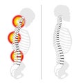 Slipped Disc Prolapse Back Pain Spine