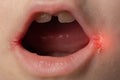 slit-like impetigo in a little girl in the corners of her mouth. Skin wounds. Dermatological bacterial disease. Sticky Royalty Free Stock Photo