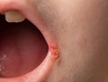 slit-like impetigo in a little girl in the corners of her mouth. Skin wounds. Dermatological bacterial disease. Sticky Royalty Free Stock Photo