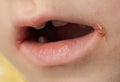 slit-like impetigo in a little girl in the corners of her mouth. Skin wounds. Dermatological bacterial disease. Sticky Royalty Free Stock Photo