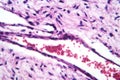 A small blood vessel with red blood cells in neurofibroma tissue sample, light micrograph