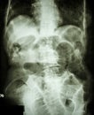 Small bowel obstruction