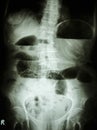 Small bowel obstruction