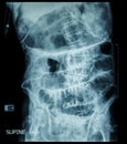 Small bowel obstruction ( film x-ray abdomen ( supine position ) : show small bowel and stomach dilate ) ( step ladder pattern ) Royalty Free Stock Photo