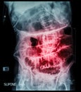 Small bowel obstruction ( film x-ray abdomen ( supine position ) : show small bowel and stomach dilate ) ( step ladder pattern ) Royalty Free Stock Photo