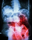 Small bowel obstruction. Film X-ray abdomen supine : show small bowel dilated due to small bowel obstruction Royalty Free Stock Photo