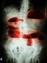 Small bowel obstruction