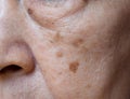 Small brown patches called age spots on face of Asian elder woman. They are also called liver spots, senile lentigo, or sun spots