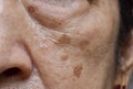 Small brown patches called age spots on face of Asian elder woman. They are also called liver spots, senile lentigo, or sun spots