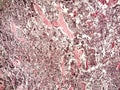 Small-cell lung cancer of a human Royalty Free Stock Photo