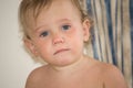 Small child with redness on the skin, suffering Royalty Free Stock Photo