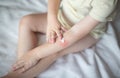 A small child smears redness on the hand with baby cream. The concept of treatment and skin care with a cream, rash and peeling in Royalty Free Stock Photo