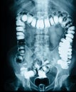 Small intestine obstruction Film X-ray