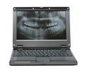 Small laptop with dental picture of jaw