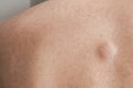 Small lipoma on the back of caucasian man Royalty Free Stock Photo