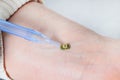 A small microcircuit lies on the wrist of a human hand, is pressed by a medical instrument next to a vein, Health Modification