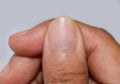 Small or missing lunula or half-moons at fingernail with longitudinal lines