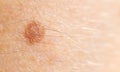 Small mole nevus on human skin, carcinoma. Background, macro