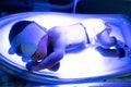 The baby lies under an ultraviolet lamp with jaundice Royalty Free Stock Photo