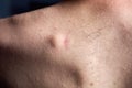 Small round lipoma on the upper back of young caucasian man. The lipoma is next to the scar left by a previous lipoma that became