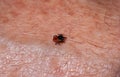 Small tick Ixodes ricinus crawling on human skin