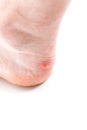 Small unpopped blister on heel, isolated on white background, close-up with selective focus.