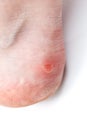 Small unpopped blister on heel, isolated on white background, close-up with selective focus.