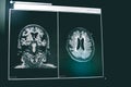 Small vessel disease and dementia on film MRI
