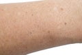 Small white and brown spots on the skin of senior man arm