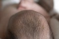 Small yellow dry peel crusts on the babyÃ¢â¬â¢s head. Seborrheic dermatitis, dandruff in the hair of a newborn