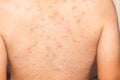 Smallpox Royalty Free Stock Photo