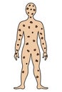 Smallpox on the human body. Color vector illustration. The face and body of the patient is covered with spots.