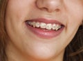 Smile with braces