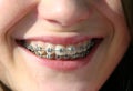 Smile with brackets on teeth