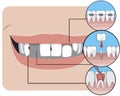 A smile with caries and crooked teeth, flat vector stock illustration with braces, molar dental implant and pulpitis as a concept