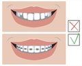 A smile with crooked teeth and with metal braces before and after the dental clinic, a vector stock illustration with molars as a