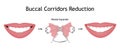 The smile with large and dark buccal corridor before and after the orthotropics or orthotropics correction. Vector