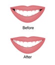 The smile with large and dark buccal corridor before and after correction. Vector illustration. Dark spaces at the edge