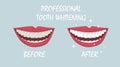 The smile of a man with his mouth wide open. Tooth whitening, tooth colour comparison before and after the procedure. Daily oral