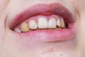 smile of restored teeth in a teenager with a corrected bite. Dental care