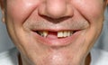 Smile without teeth with bristles Royalty Free Stock Photo