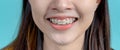 Smiling Asian woman wearing orthodontic retainer on blue screen background. Dental care and teeth Royalty Free Stock Photo