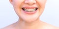 Smiling Asian woman wearing orthodontic retainer. Dental care and healthy