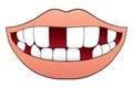 Mouth With Missing Teeth Royalty Free Stock Photo