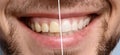 Smiling man before and after teeth whitening procedure Royalty Free Stock Photo