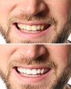 Smiling man before and after teeth whitening procedure Royalty Free Stock Photo