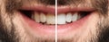 Smiling man before and after teeth whitening procedure Royalty Free Stock Photo