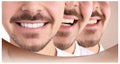 Smiling man before and after teeth whitening procedure on color background Royalty Free Stock Photo