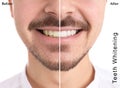 Smiling man before and after teeth whitening procedure on light background Royalty Free Stock Photo
